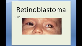 Pathology 509 a Retinoblastoma Eye Tumor Retina Child Flexner WinterSteiner Home Wright Rosette [upl. by Aiuqcaj]