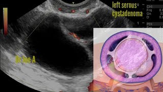 Ovary Mucinous cystadenoma [upl. by Leiba]