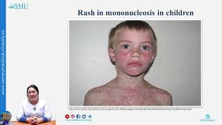 Infectious mononucleosis in children [upl. by Hasina]