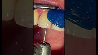 Fixing chipped tooth with composite bonding at the dentist [upl. by Anuqahs]