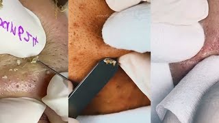 13 Minutes Of Top ASMR Pimple Popping Video [upl. by Lucho]