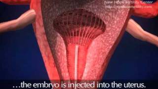 Embryo Transfer [upl. by Glynis]