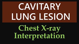 Cavitary Lung Lesion  Chest Xray Interpretation [upl. by Florance]