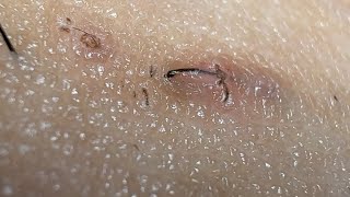 JUICY SATISFYING INGROWN HAIR PULL😍😍😍 [upl. by Pietra498]