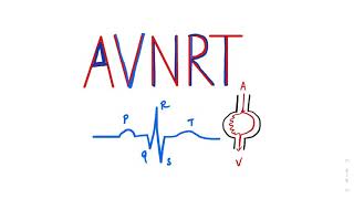 Atrioventricular Nodal Reentrant Tachycardia AVNRT SVT ecgtutorial cardiology AVRT Arrhythmia [upl. by Neeruan]