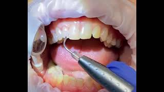 Laser Bacterial Reduction with the Epic Hygiene Diode Laser [upl. by Eckblad]