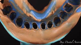 Feldspathic Veneers [upl. by Norman]