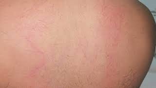 Dermatographism also known as dermographism urticaria or urticaria factitia is an urticarial Rash [upl. by Lemrac900]