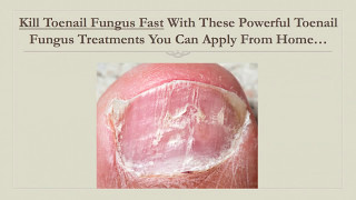 Kill Toenail Fungus Fast With This Powerful Toenail Fungus Treatment You Can Apply From Home [upl. by Laet]