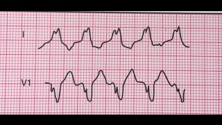 Tachycardie ventriculaireMorphologie du bloc de branche gauche [upl. by Brandt991]
