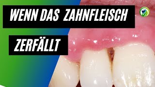 Wenn das Zahnfleisch zerfällt  eine drohende Gefahr  NUGANUG NUPANUG  Zahnfleischerkrankung [upl. by Wasson]