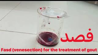 Fasd Venesectionan effective blood letting procedure in Unani Medicine [upl. by Clarence837]