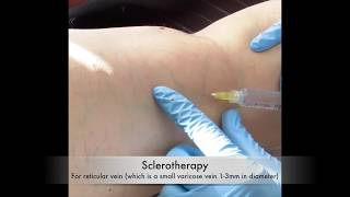 Sclerotherapy for varicose vein  Live sclerotherapy video [upl. by Zashin]