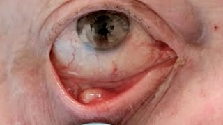 Chalazion or Stye What is the Difference [upl. by Surtemed354]