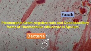 Haemophilus influenzae in Sputum  Coccobacillary forms of Haemophilus influenzae [upl. by Naharba]