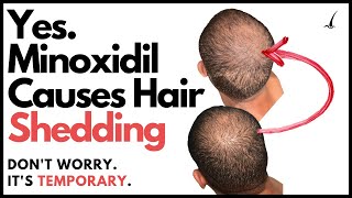 Does Minoxidil Make You Go Bald The TRUTH about Minoxidil Hair Shedding Phase [upl. by Anrim]