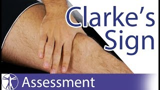 Clarkes Sign  Patellar Grind Test  Patellofemoral Pain  Chondromalacia Patellae [upl. by Kcirdneked]