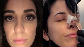 MY NOSE JOB REVEAL amp 2 WEEKS POST OP  Revision Rhinoplasty Experience in Turkey  Dr Umit Taskin [upl. by Harleigh]