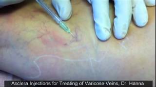 Asclera Injections for Treating of Varicose and Spider Veins by Dr Hanna [upl. by Atekin245]