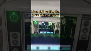 Normal Sinus Rhythm with Atrial Ectopic beats ecg cardiology [upl. by Rotciv]