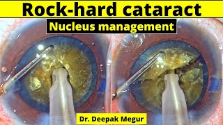 Brown rock hard cataract  Nucleus management  Dr Deepak Megur [upl. by Carlock]