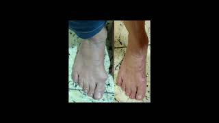 Joanete e pé plano joanete peplano halluxvalgus bunion bunions buniontreatment [upl. by Hulton]