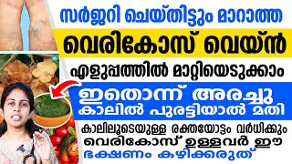 സർജറി ചെയ്തിട്ടും വെരികോസ് മാറുന്നില്ലേ ഈ ഇല കാലിൽ അരച്ചുപുരട്ടിയാൽ രക്തയോട്ടം വർധിക്കും  vericose [upl. by Nadab200]