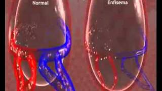 Enfisema Pulmonar [upl. by Collette683]