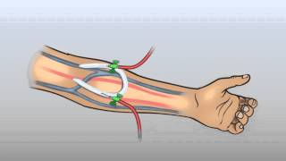 ARTERIOVENOUS GRAFT [upl. by Anrapa]