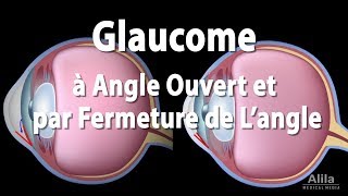 Pathologie du Glaucome Animation [upl. by Peta]