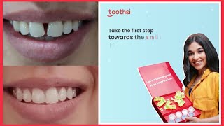 Toothsi Impression kit Recieved for Invisible Aligners [upl. by Lleze]