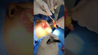 Buccal Fat Removal Surgery Cost in Mumbai  Dr Parit Ladani [upl. by Germain]