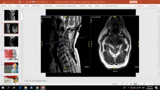 MIELOPATIA CERVICAL DEGENERATIVA [upl. by Aniras]