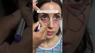 Patient Review Before and After Trifecta Lift with Dr Kami Parsa  6 Weeks Postop [upl. by Horatius448]