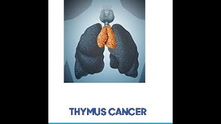 thymoma with pleural mets [upl. by Jourdan246]