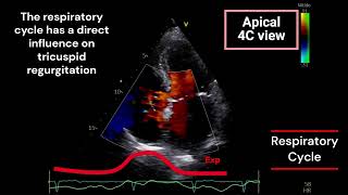 Tricuspid Regurgitation and Respiratory Cycle [upl. by Tiphani947]