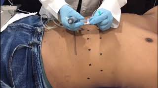 HIDROLIPOCLASIA en abdomen [upl. by Leunam]