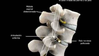 Espondilolistesis [upl. by Schrader]