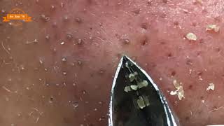 blackheads whiteheads treatment  ब्लाक हेड्ज़ को कैसे निकाले  त्वचा के डॉक्टर [upl. by Annahsat]