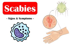 Scabies  Signs amp Symptoms What Are The Commonest Signs amp Symptoms Of Scabies [upl. by Arela]