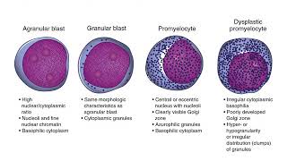 Myelodysplastic Syndrome [upl. by Neelehtak]