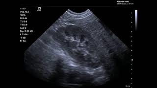 Low flow colour Doppler using the 11M3 microconvex probe on Siemens Acuson P500  paediatric kidney [upl. by Mauve]