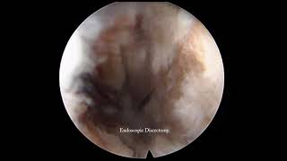 L5S1 endoscopic lumbar interbody fusion [upl. by Ferree413]