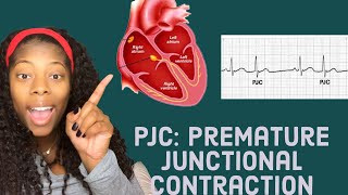 Basic EKG Identifying premature junctional contractions PJCS [upl. by Gipps]