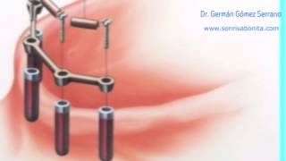 implantes dentales explicacion facil de entender  vídeo para pacientes [upl. by Hanad226]