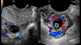 CORPUS LUTEUM VS ECTOPIC PREGNANCY [upl. by Theurich]