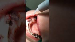 Laser gingivectomy area 23 tooth [upl. by Aramaj]