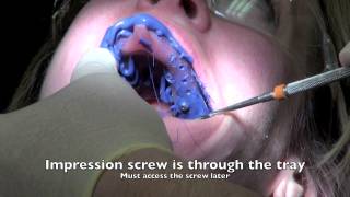 Dental Implant  Impression and Insertion of crown [upl. by Ronna]