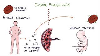 Understanding Rhesus Status and AntiD in Pregnancy [upl. by Mcclish924]