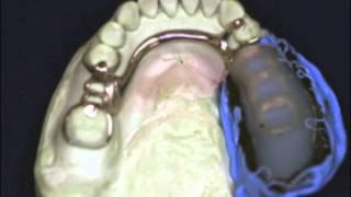 Altered Cast in Removable Partial Dentures [upl. by Suolkcin]